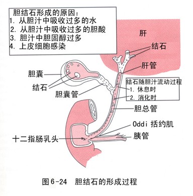 膽結石的食療法